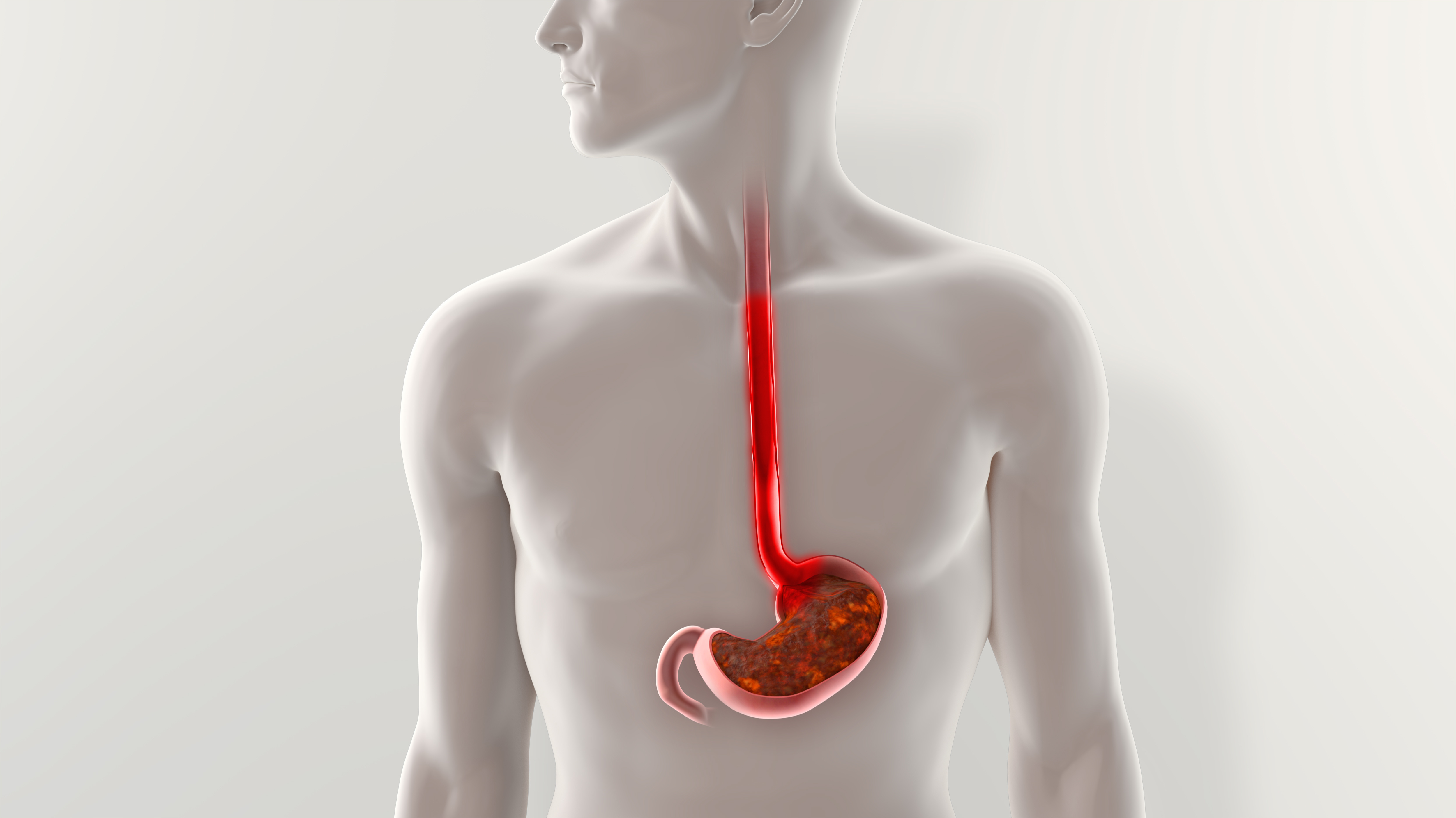 GI and Hepatology News - New Data Tie GLP1 Therapies to GERD GI and Hepatology News - New Data Tie GLP1 Therapies to GERD